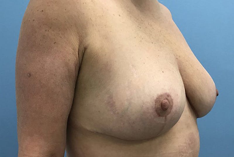 Breast Reduction Before & After Gallery - Patient 120902825 - Image 4
