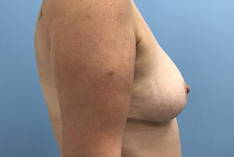 Breast Reduction Before & After Gallery - Patient 120902825 - Image 6