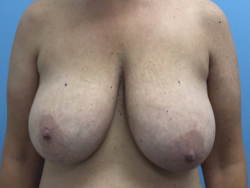 Breast Reduction Gallery - Patient 120902837 - Image 1