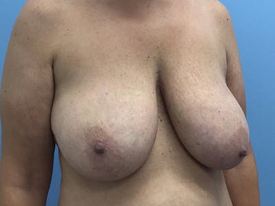 Breast Reduction Before & After Gallery - Patient 120902837 - Image 1