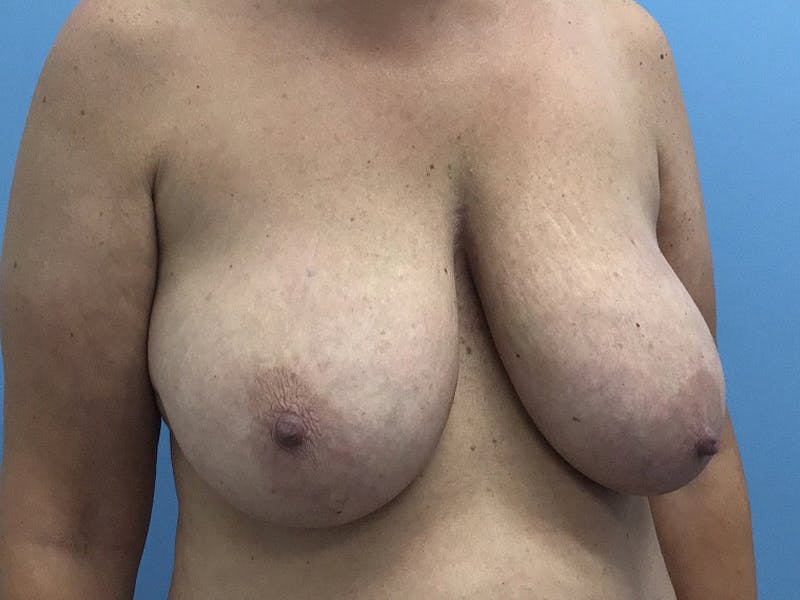 Breast Reduction Before & After Gallery - Patient 120902837 - Image 3