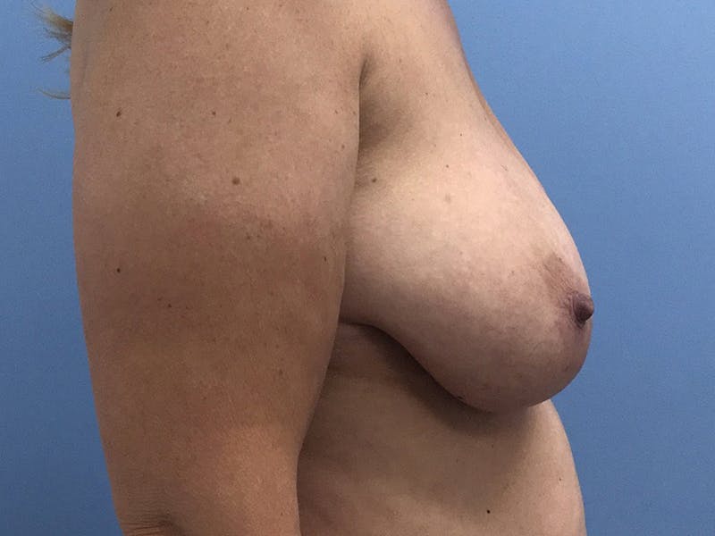 Breast Reduction Before & After Gallery - Patient 120902837 - Image 5
