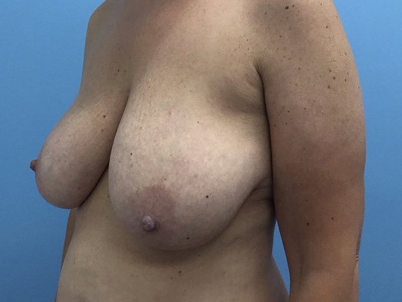 Breast Reduction Gallery - Patient 120902837 - Image 7