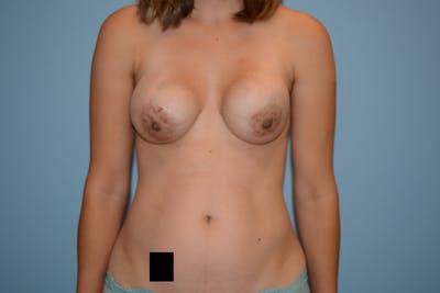 乳房翻修前后图库-患者120903147 -图1