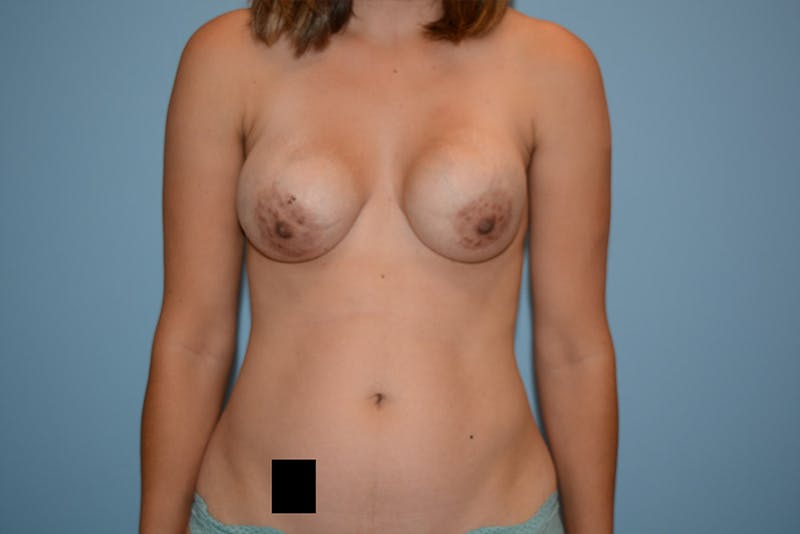 Breast Revision Gallery - Patient 120903147 - Image 1