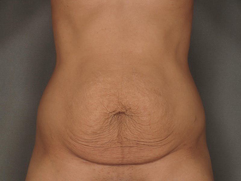 Mommy Makeover Before & After Gallery - Patient 120903499 - Image 11