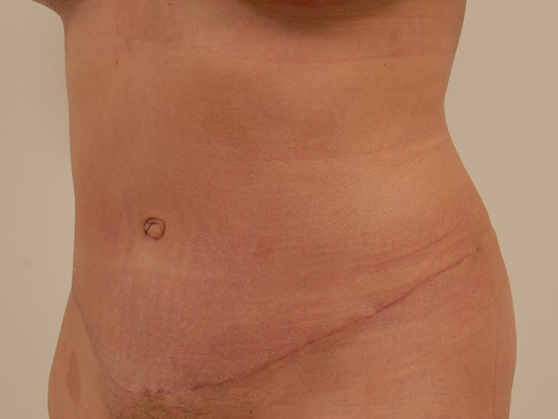 Mommy Makeover Before & After Gallery - Patient 120903523 - Image 18