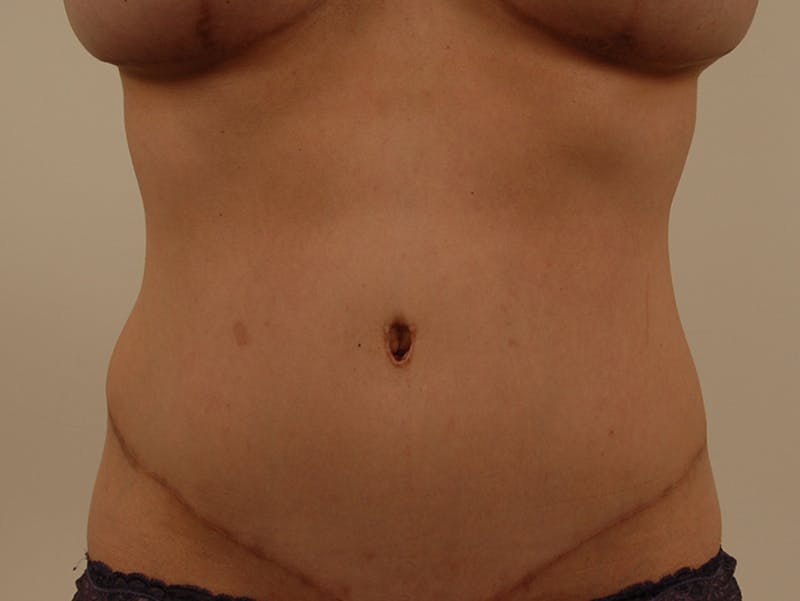 Mommy Makeover Before & After Gallery - Patient 120903540 - Image 12