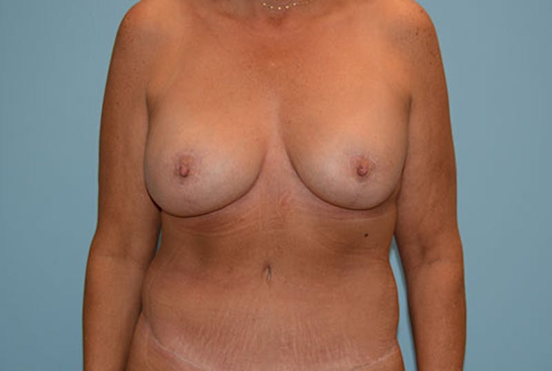 Mommy Makeover Before & After Gallery - Patient 120903601 - Image 2