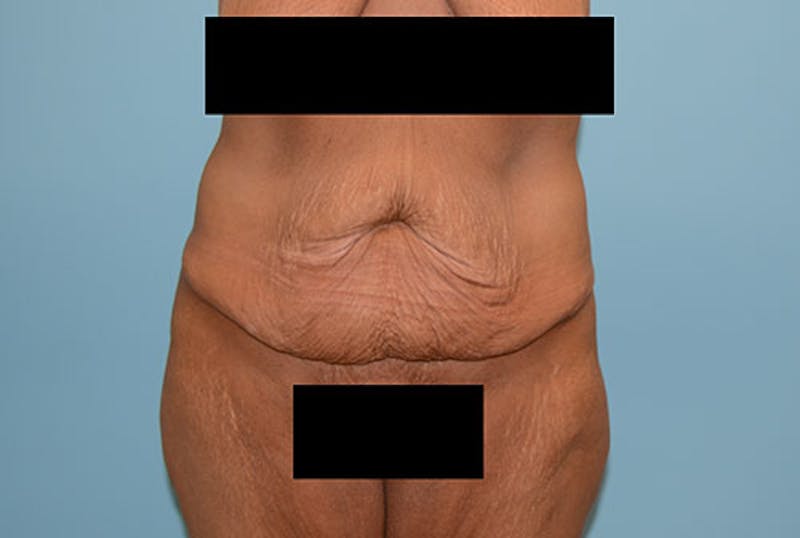 Mommy Makeover Before & After Gallery - Patient 120903601 - Image 7