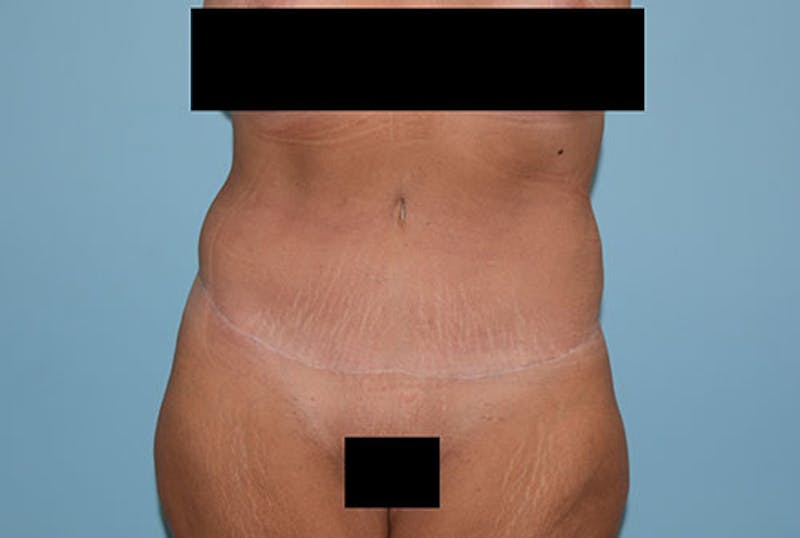 Mommy Makeover Before & After Gallery - Patient 120903601 - Image 8