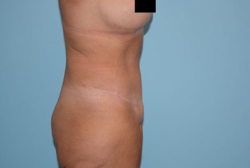 Mommy Makeover Before & After Gallery - Patient 120903601 - Image 10