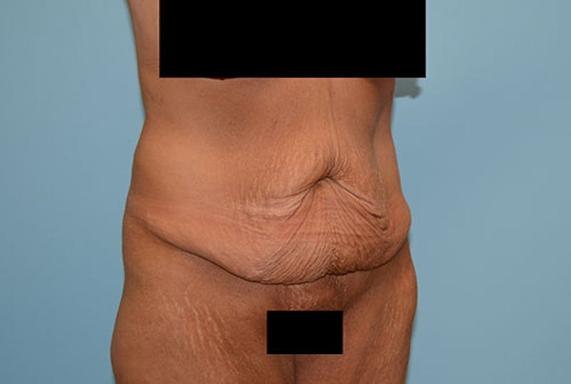 Mommy Makeover Before & After Gallery - Patient 120903601 - Image 11