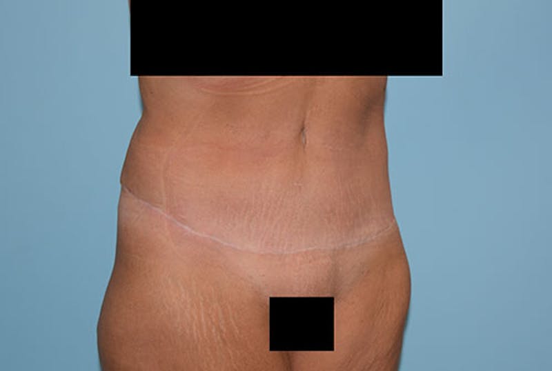 Mommy Makeover Before & After Gallery - Patient 120903601 - Image 12