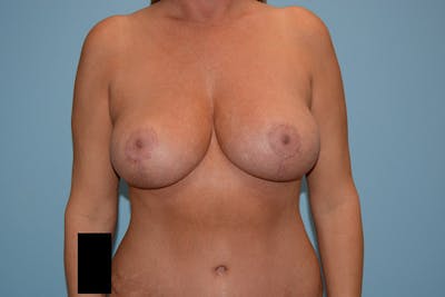 Mommy Makeover Before & After Gallery - Patient 120903614 - Image 2