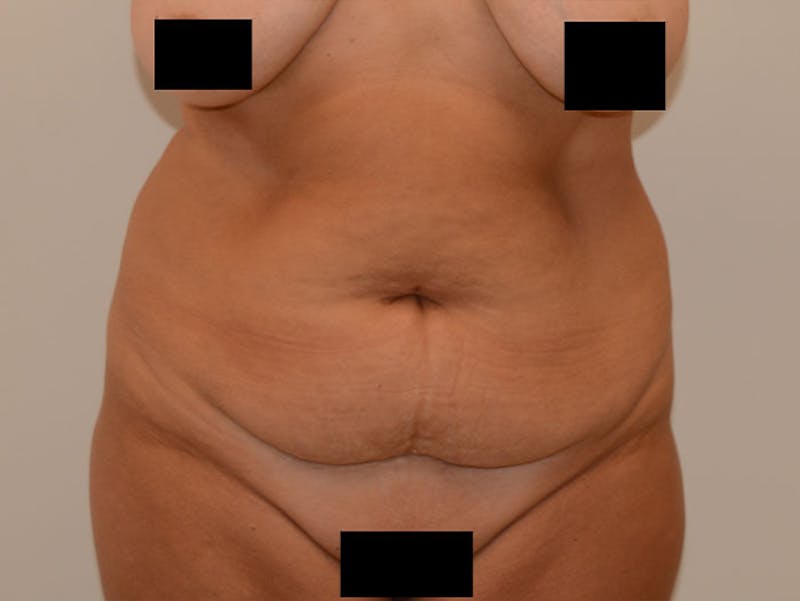 Mommy Makeover Before & After Gallery - Patient 120903621 - Image 7