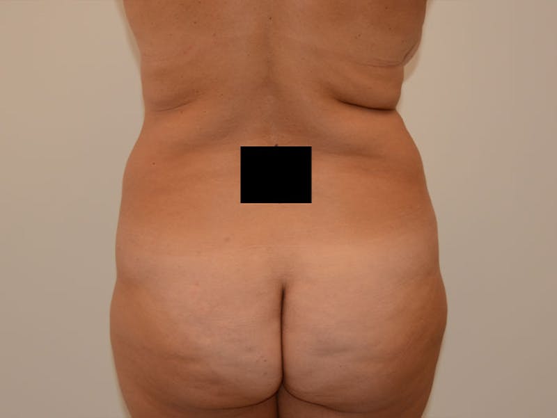 Mommy Makeover Before & After Gallery - Patient 120903621 - Image 9