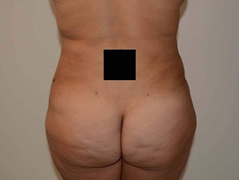 Mommy Makeover Before & After Gallery - Patient 120903621 - Image 10