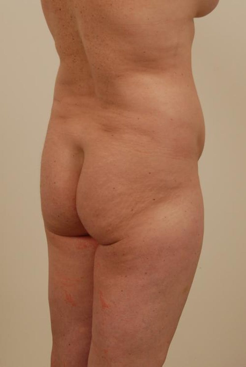 Brazilian Butt Lift Before & After Gallery - Patient 120904921 - Image 3