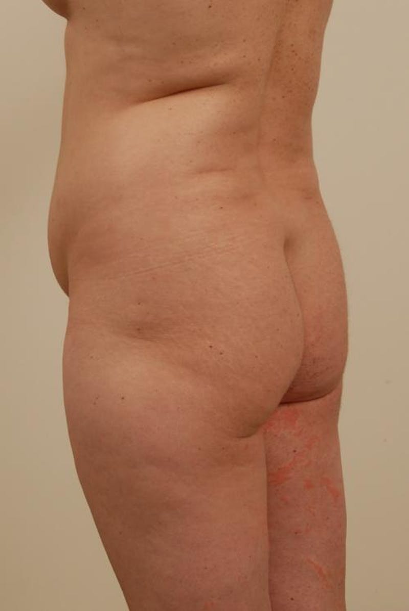 Brazilian Butt Lift Before & After Gallery - Patient 120904921 - Image 5