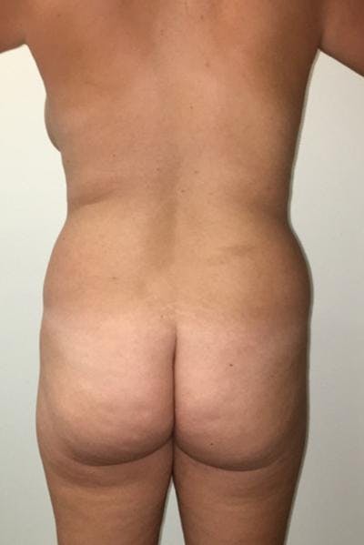 Brazilian Butt Lift Before & After Gallery - Patient 120904922 - Image 1