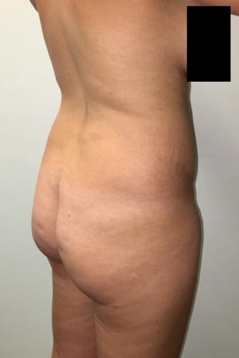 Brazilian Butt Lift Before & After Gallery - Patient 120904922 - Image 3