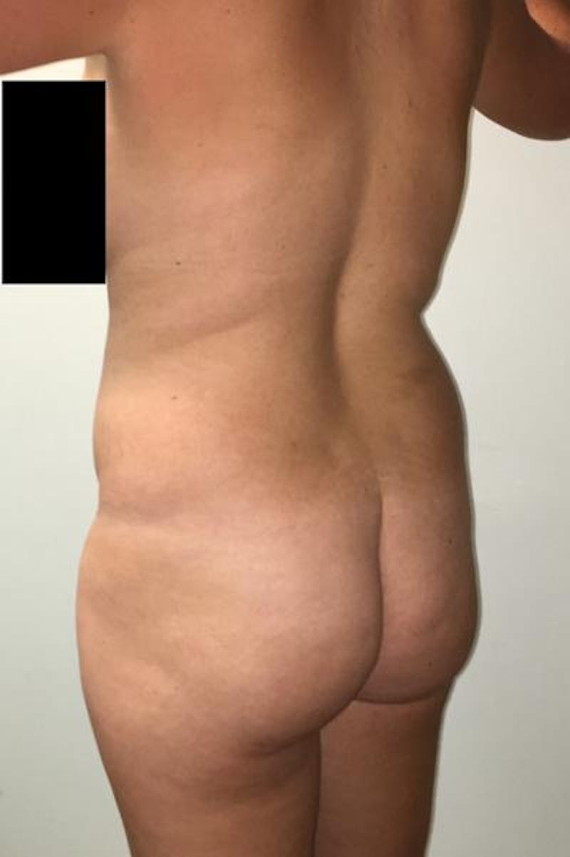 Brazilian Butt Lift Before & After Gallery - Patient 120904922 - Image 5