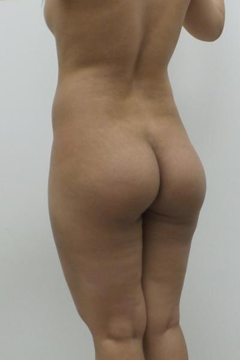 Brazilian Butt Lift Before & After Gallery - Patient 120904926 - Image 5