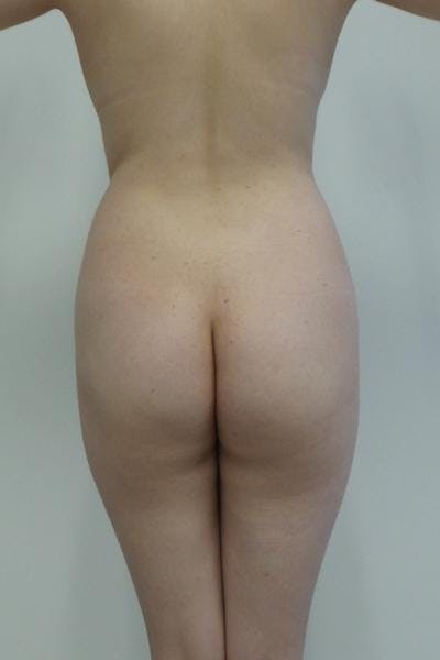 Brazilian Butt Lift Before & After Gallery - Patient 120904928 - Image 1