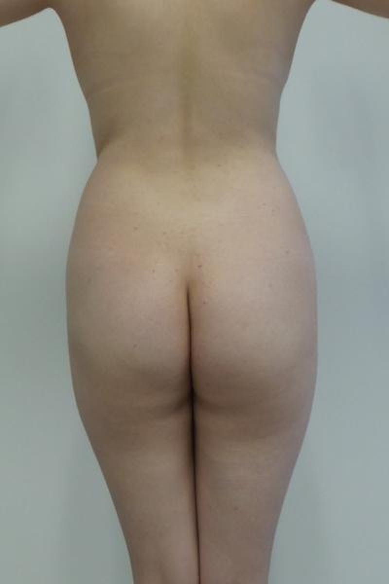 Brazilian Butt Lift Gallery - Patient 120904928 - Image 1