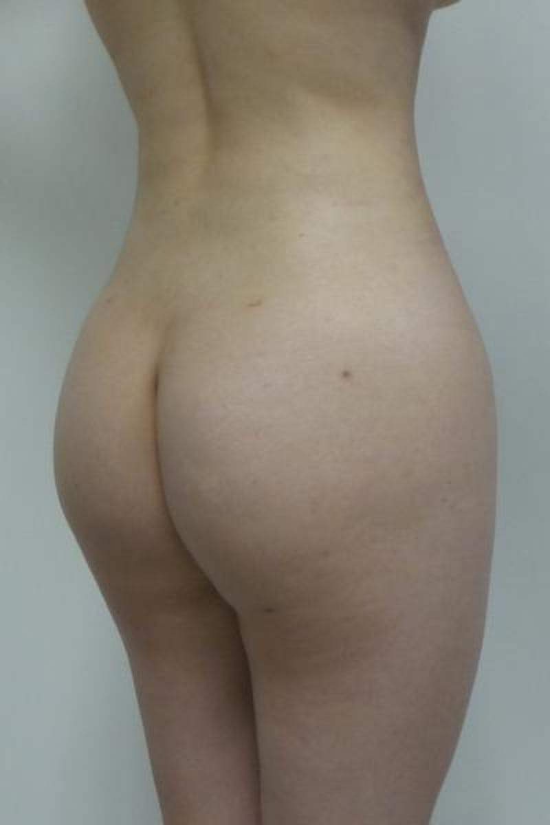 Brazilian Butt Lift Before & After Gallery - Patient 120904928 - Image 4