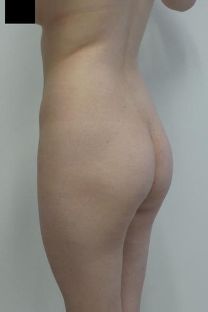 Brazilian Butt Lift Before & After Gallery - Patient 120904928 - Image 5