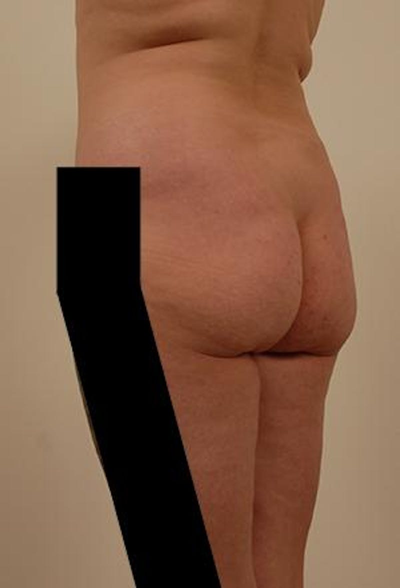 Brazilian Butt Lift Before & After Gallery - Patient 120904929 - Image 3