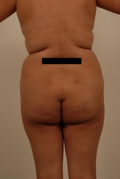 Brazilian Butt Lift Before & After Gallery - Patient 120904930 - Image 1