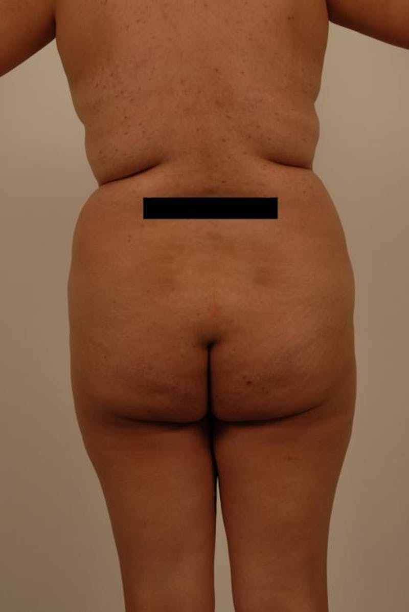 Brazilian Butt Lift Before & After Gallery - Patient 120904930 - Image 1