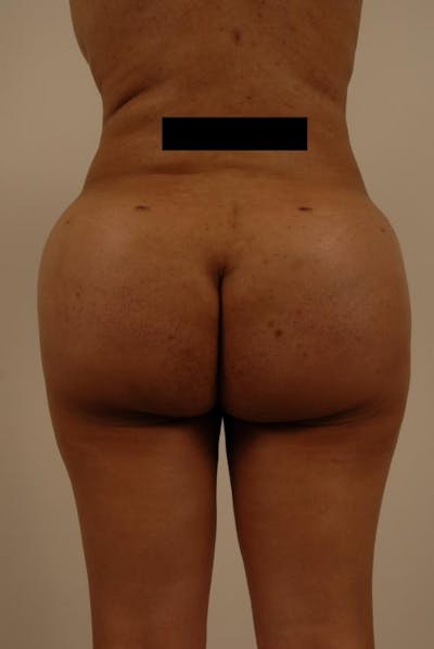 Brazilian Butt Lift Before & After Gallery - Patient 120904930 - Image 2