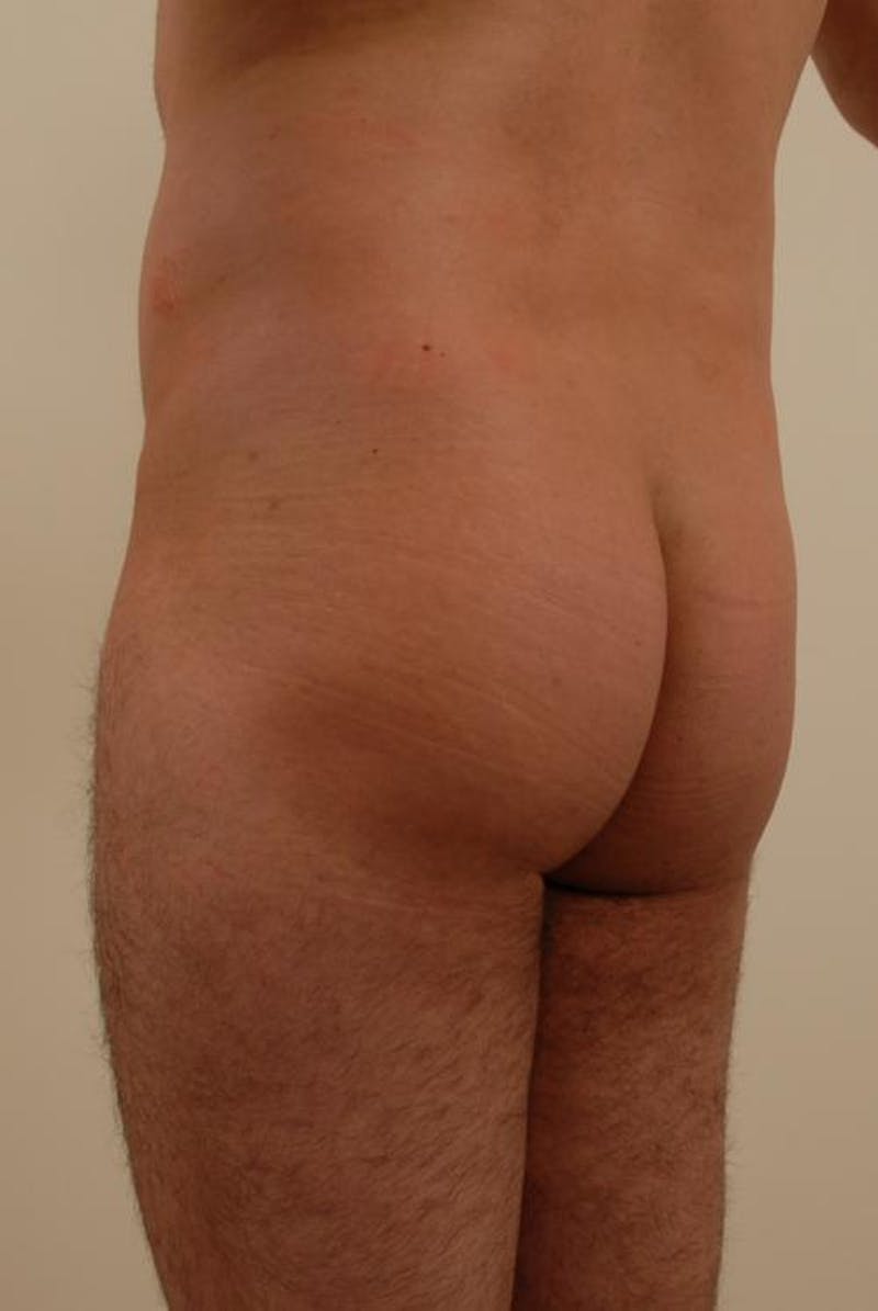 Brazilian Butt Lift Before & After Gallery - Patient 120904931 - Image 5
