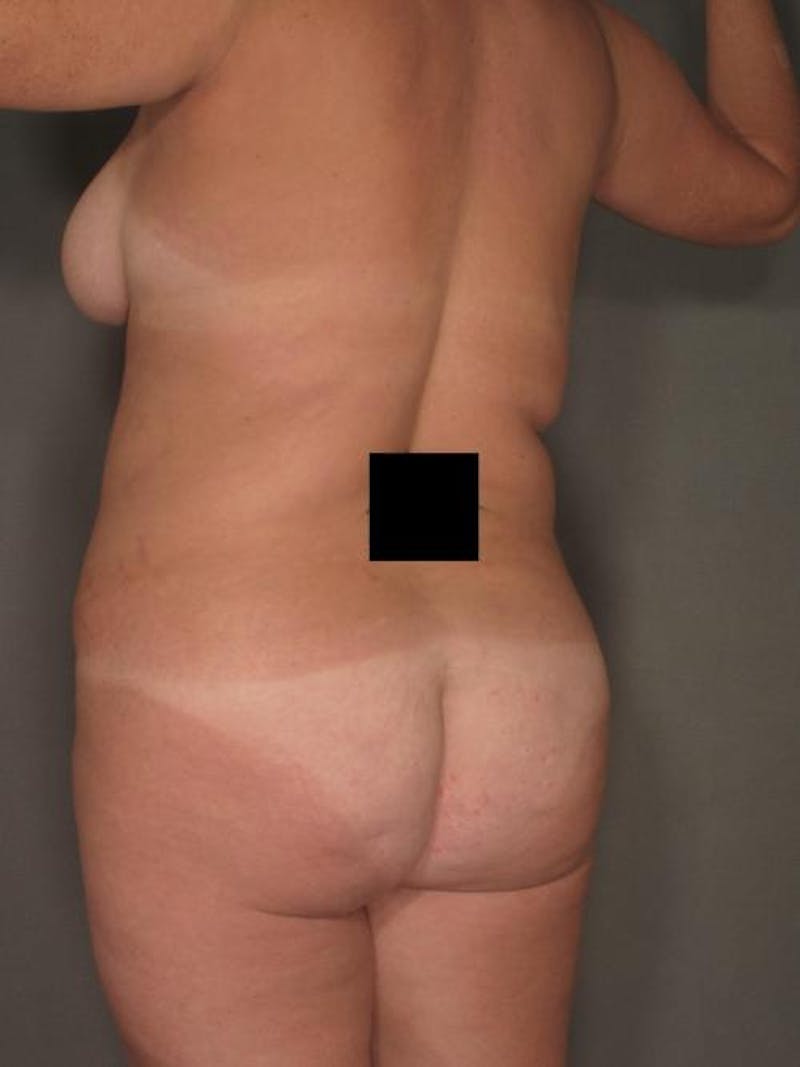 Brazilian Butt Lift Before & After Gallery - Patient 120904963 - Image 3