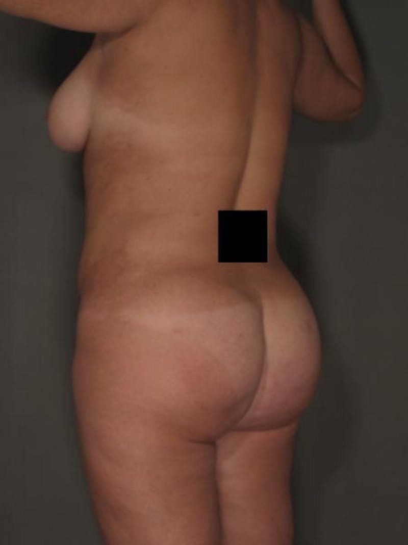Brazilian Butt Lift Before & After Gallery - Patient 120904963 - Image 4