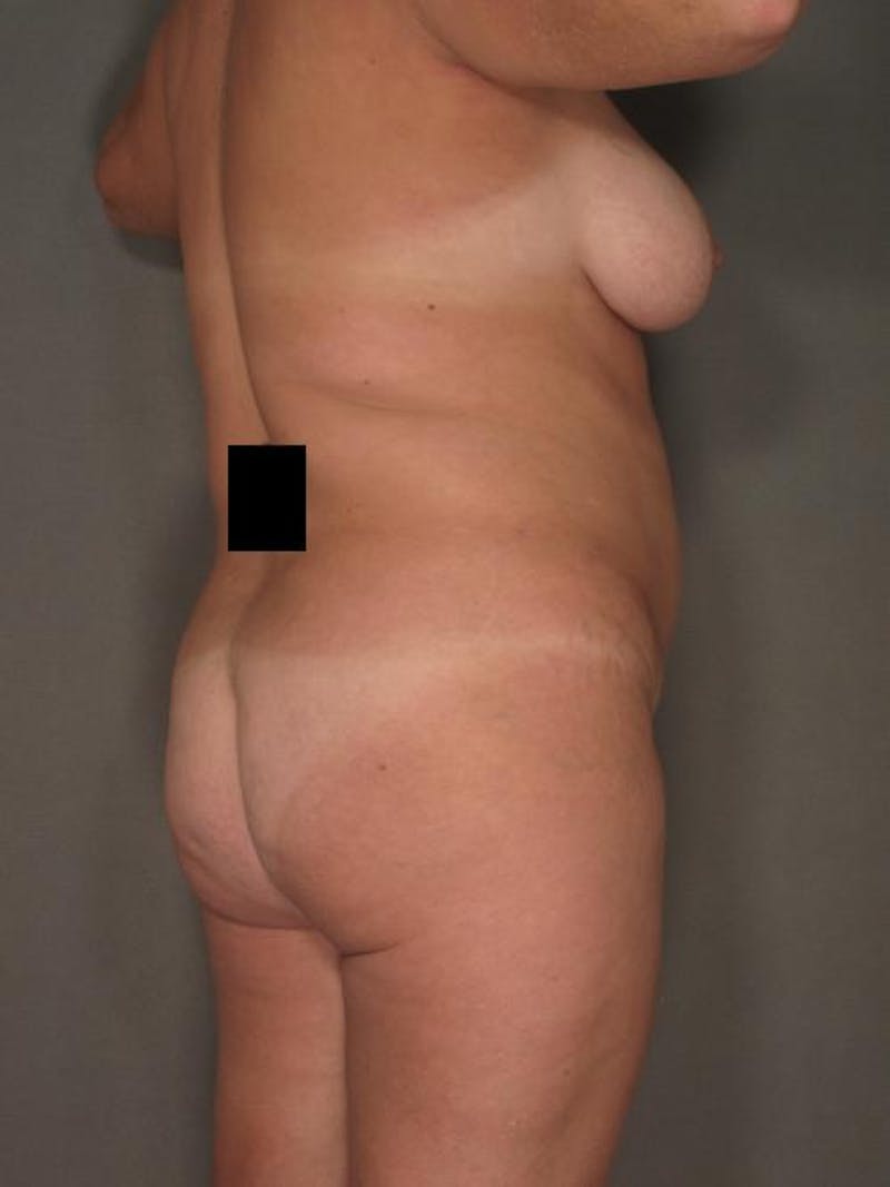 Brazilian Butt Lift Before & After Gallery - Patient 120904963 - Image 7