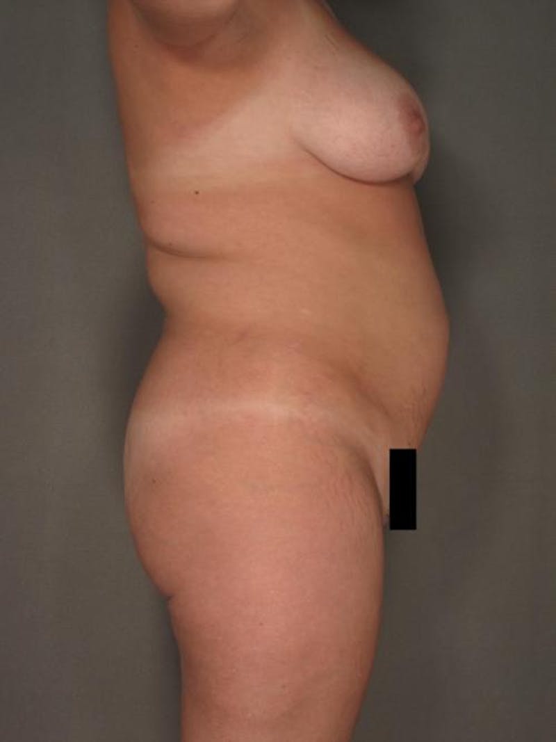 Brazilian Butt Lift Before & After Gallery - Patient 120904963 - Image 9