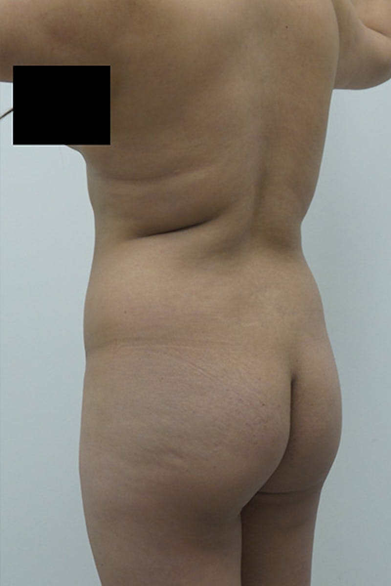 Brazilian Butt Lift Before & After Gallery - Patient 120904970 - Image 3