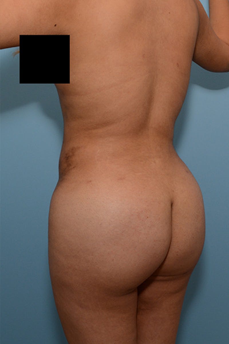 Brazilian Butt Lift Before & After Gallery - Patient 120904970 - Image 4