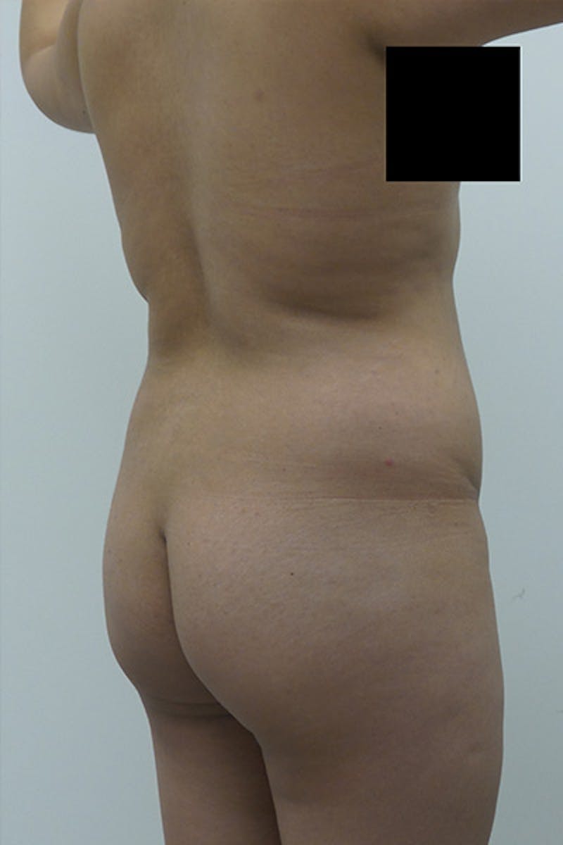 Brazilian Butt Lift Before & After Gallery - Patient 120904970 - Image 5