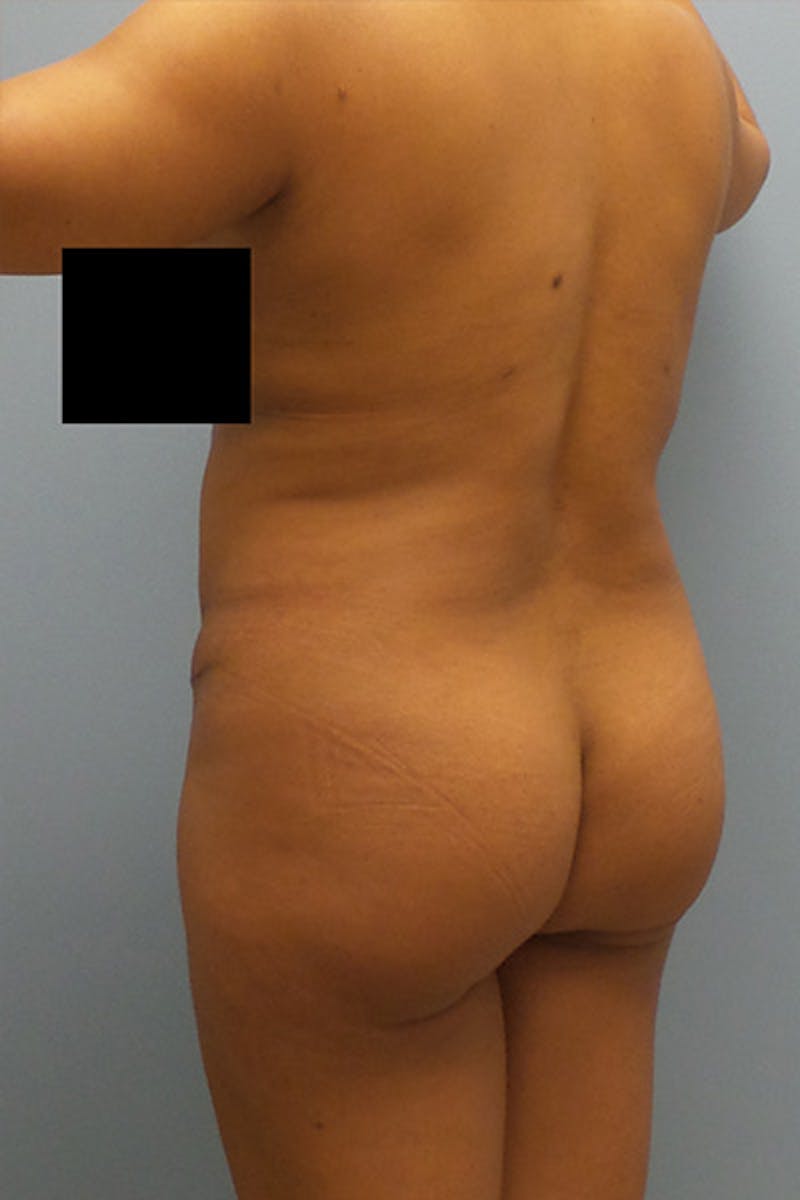 Brazilian Butt Lift Before & After Gallery - Patient 120904972 - Image 3