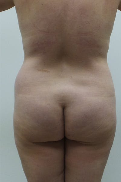 Brazilian Butt Lift Before & After Gallery - Patient 120904973 - Image 1