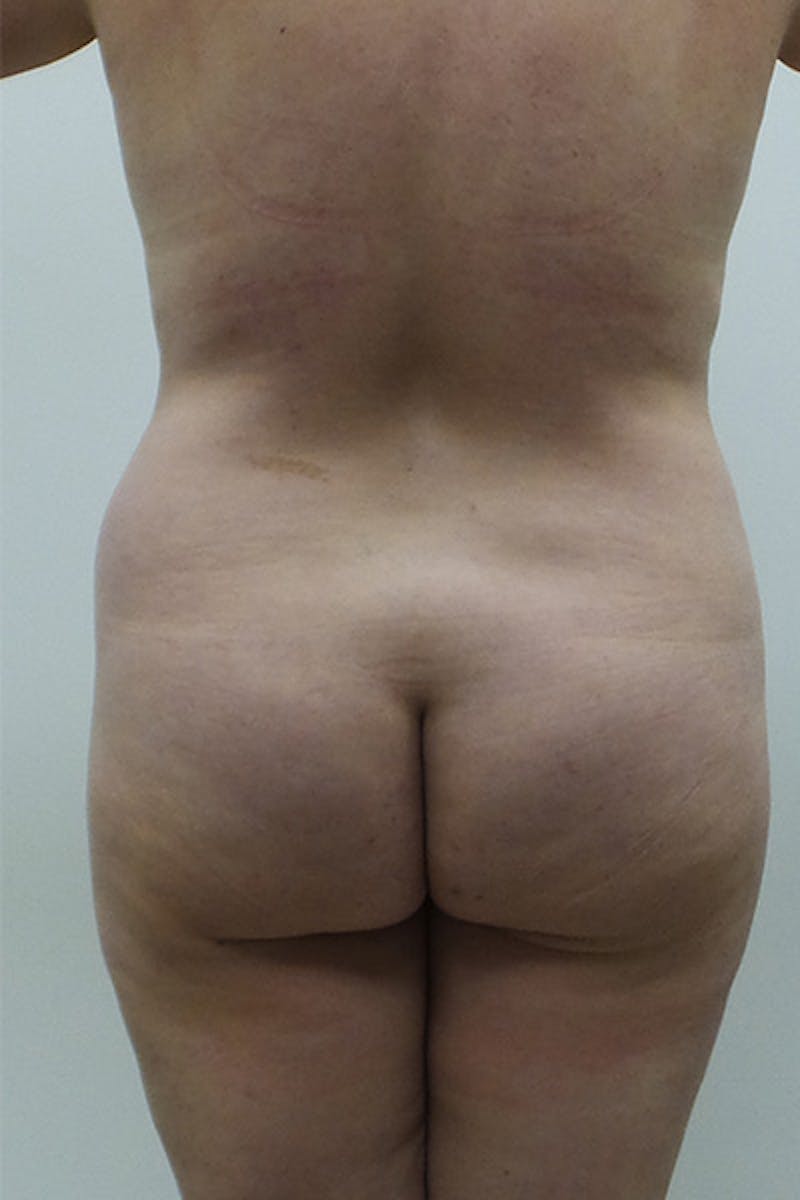 Brazilian Butt Lift Gallery - Patient 120904973 - Image 1
