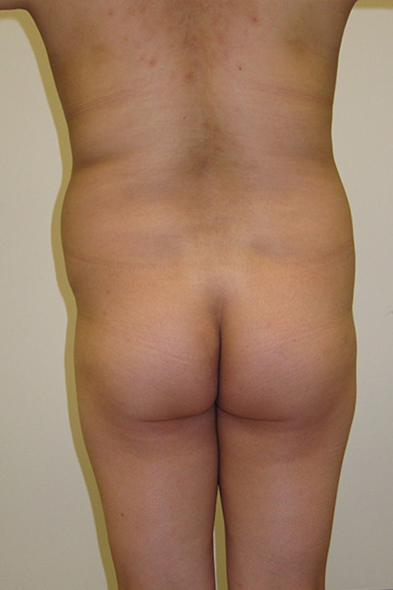 Brazilian Butt Lift Before & After Gallery - Patient 120904974 - Image 1