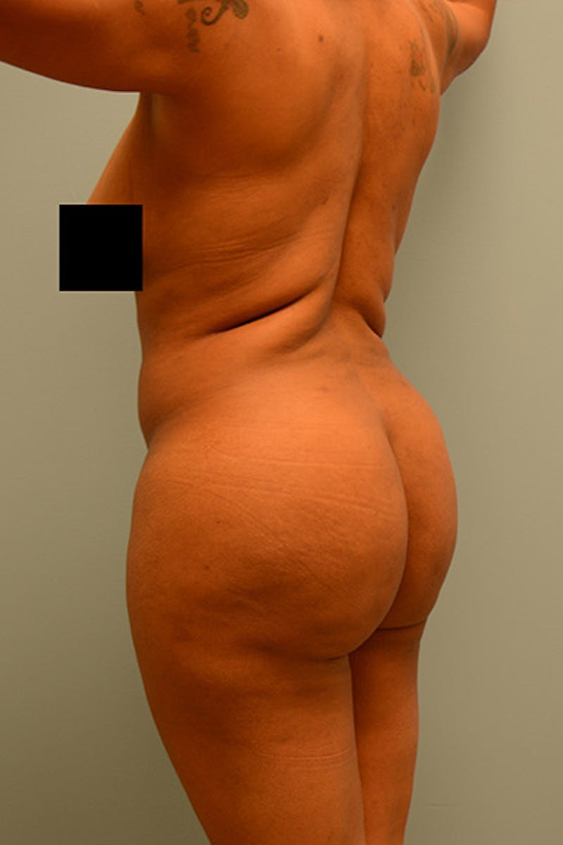 Brazilian Butt Lift Before & After Gallery - Patient 120904975 - Image 4