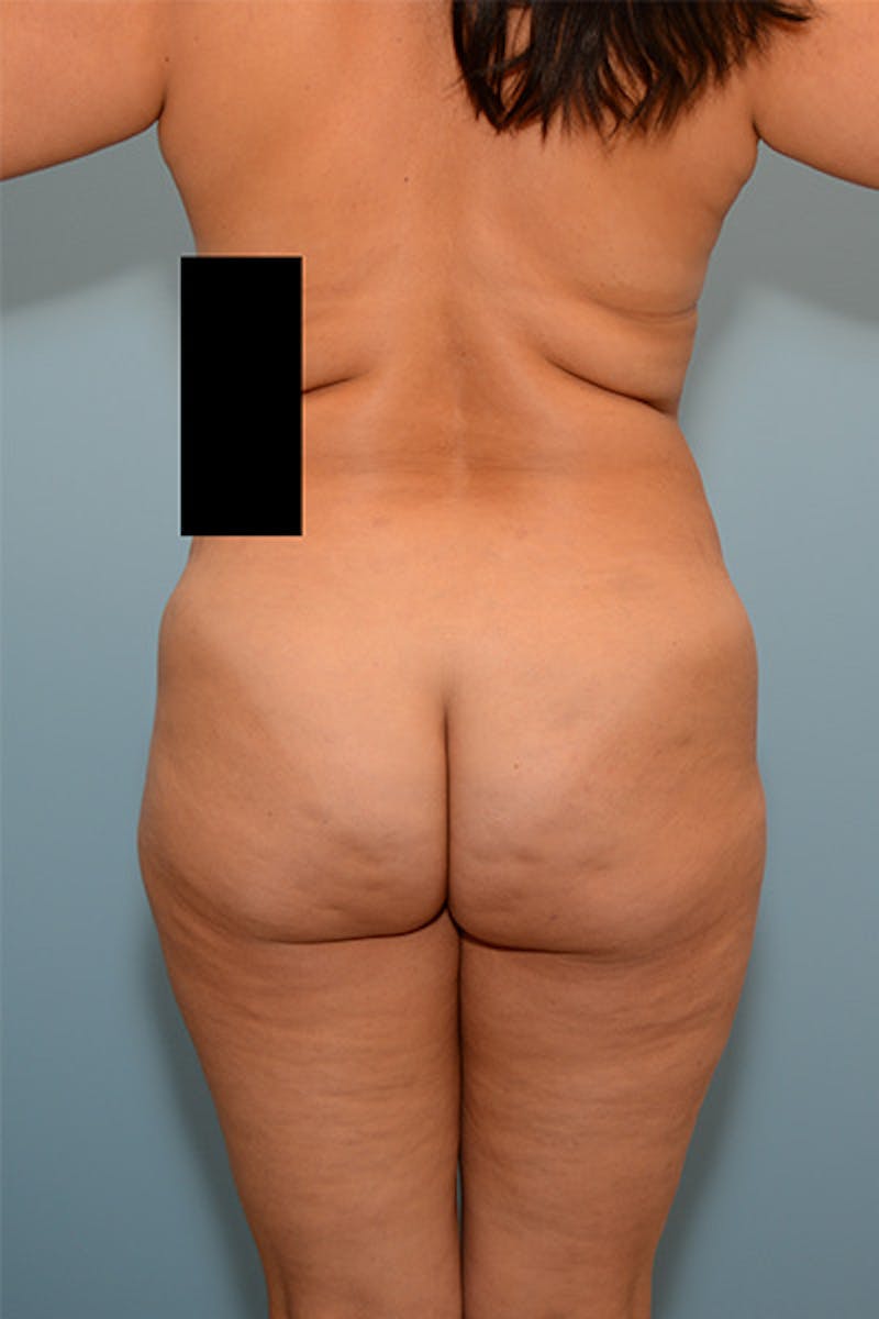 Brazilian Butt Lift Before & After Gallery - Patient 120904977 - Image 1